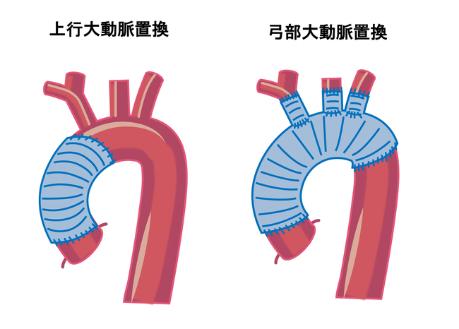 大動脈置換の図